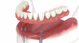 Full Mouth Implants: Cost, Procedure & Benefits