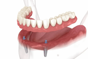 Full Mouth Implants: Cost, Procedure & Benefits