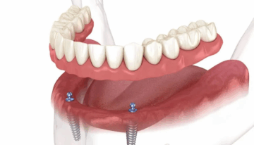 Full Mouth Implants: Cost, Procedure & Benefits